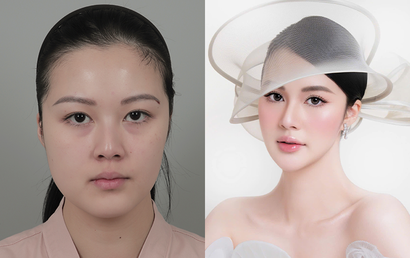 phẩu thuật mặt 2